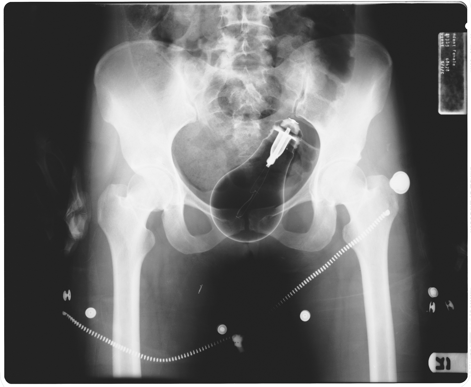 BILL-SUFF-XRAY-LIGHTBULB-IN-THE-WOMB